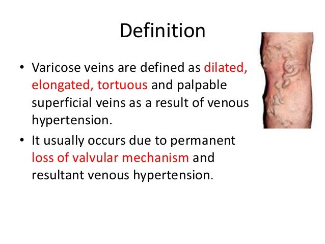 Varicose veins medical definition - Prevention Methods